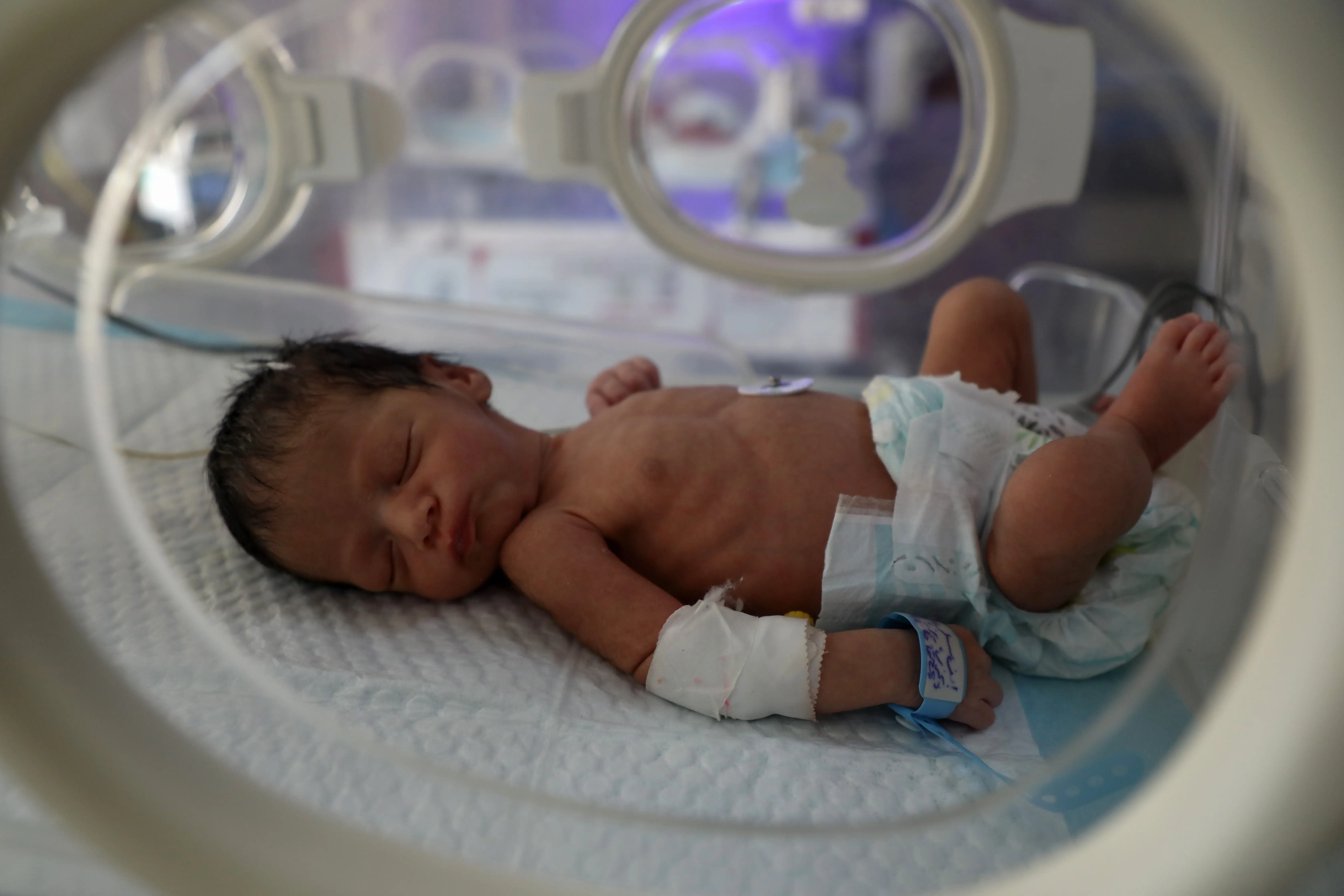 mideast gaza deiral balah prematurebaby medicalcarexxjpbee007070 20250703 pepfn0a001.jpg